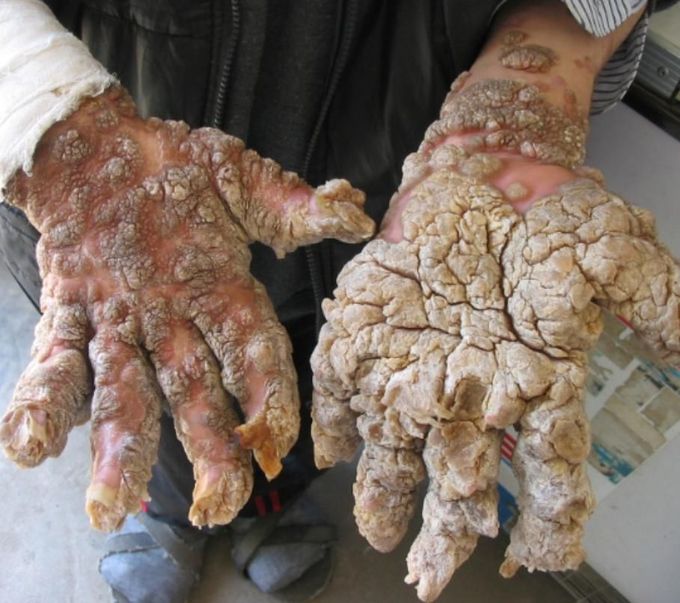 Epidermodysplasia Verruciformis