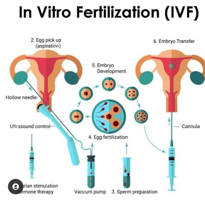 In vitro fertilization