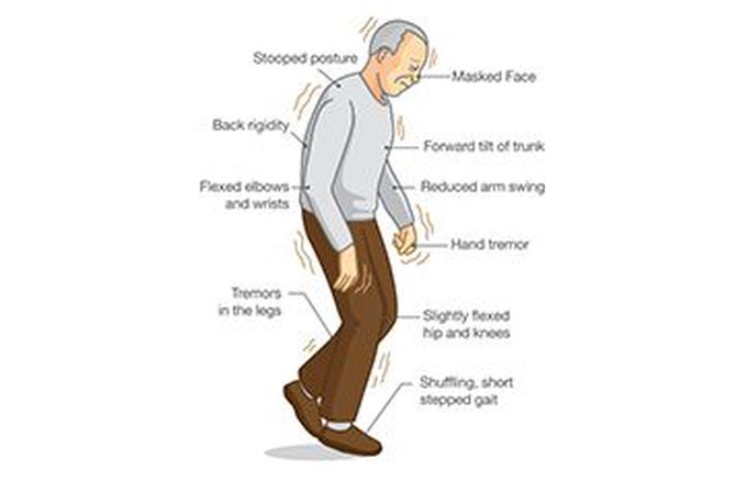 Causes of movement disorders