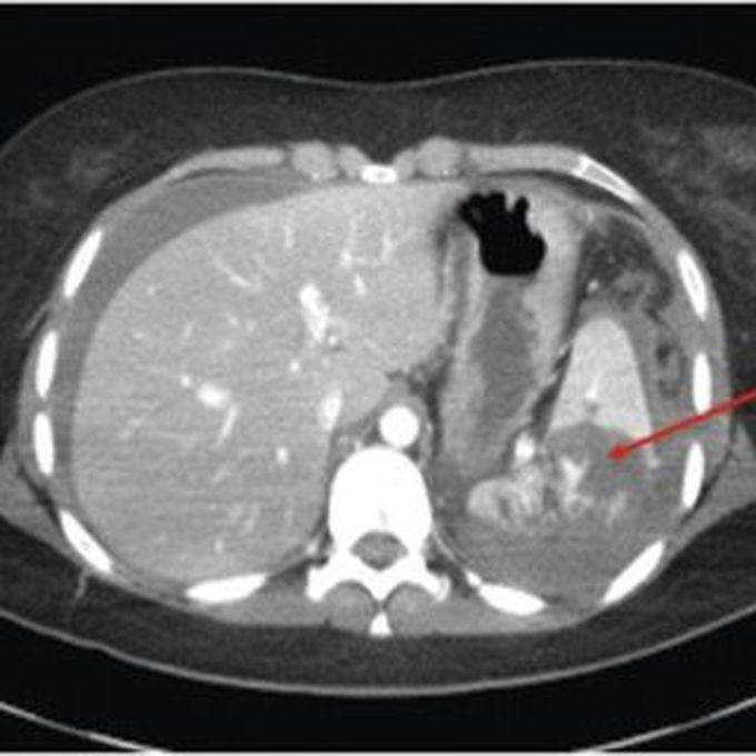 CECT abdomen, traumatic injury