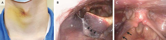 Pharyngolaryngeal Hematomas in Hemophilia A