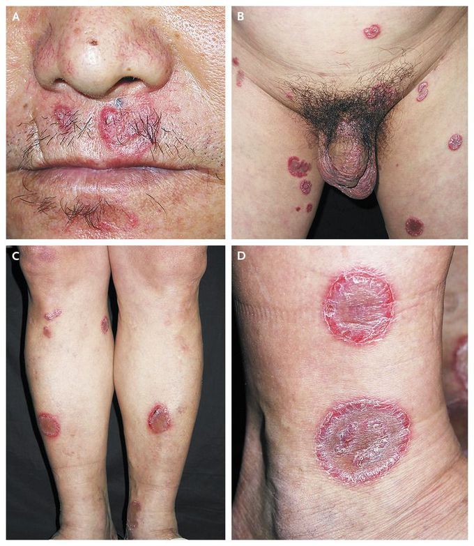 Annular Secondary Syphilis