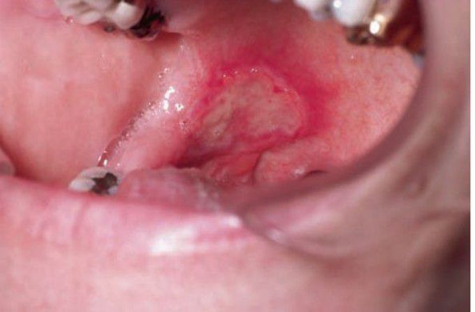 Major aphthous ulcer