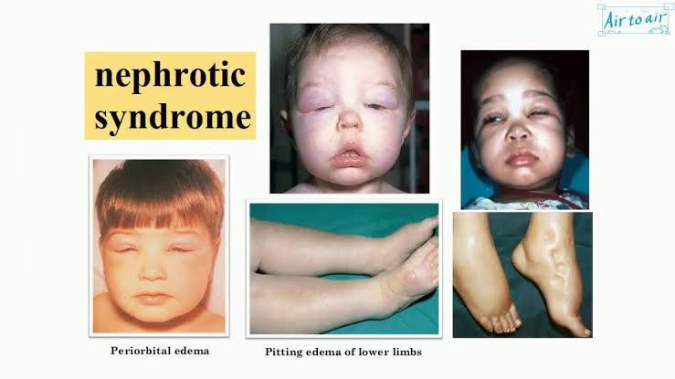 Nephrotic syndrome - MEDizzy