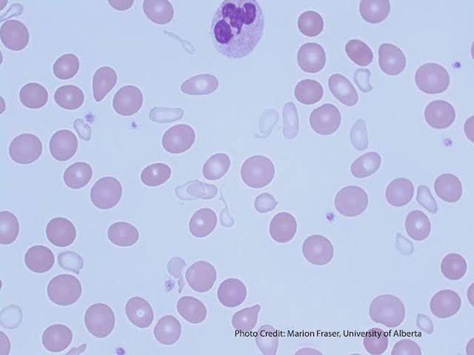 Sideroblastic anemia