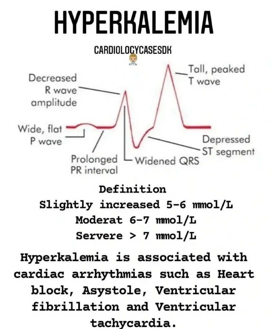 Hyperkalemia MEDizzy