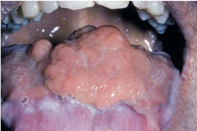 Nongingival Cyclosporine Hyperplasia