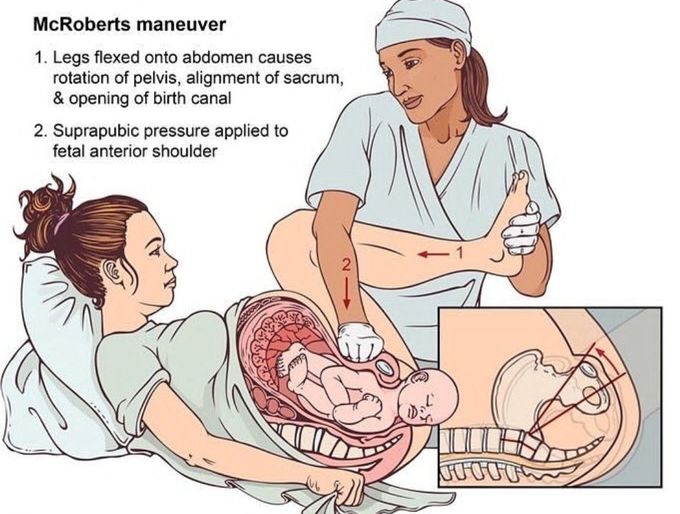 McRoberts Maneuver