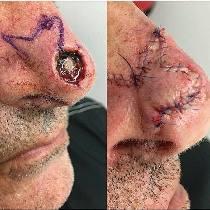 Patient after removal of a basal cell carcinoma