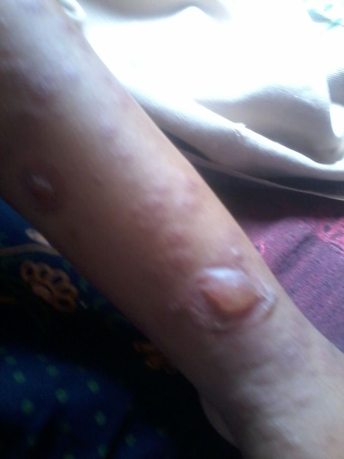 Treatment and DIAGNOSIS?
