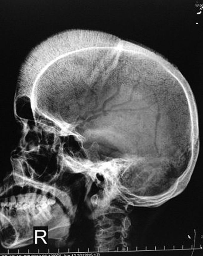 Hair on end appearance skull x-ray