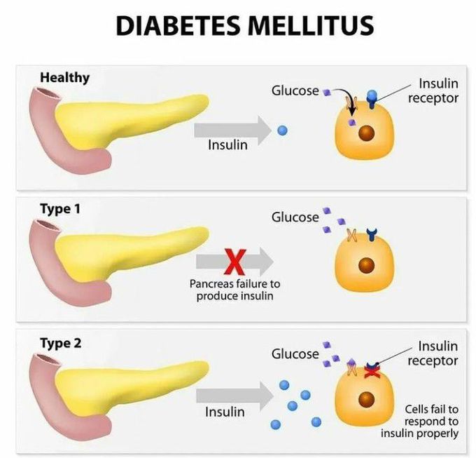 Diabetes Mellitus