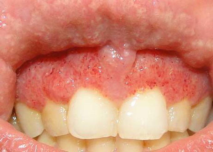 Treatment for Pyostomatitis vegetans