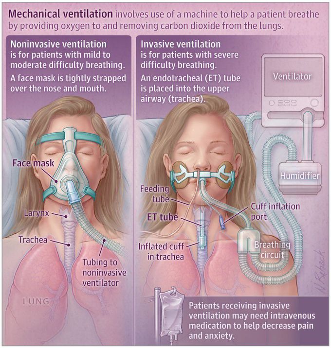 Mechanical ventilation