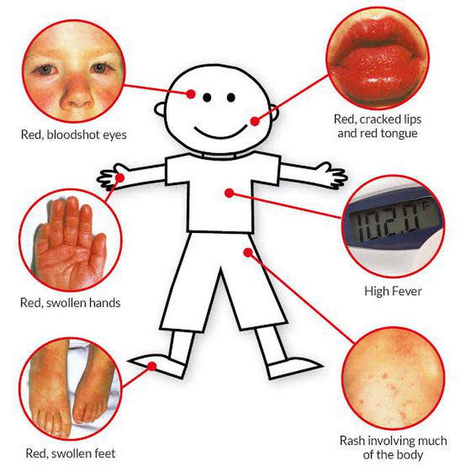 Causes of kawasaki disease