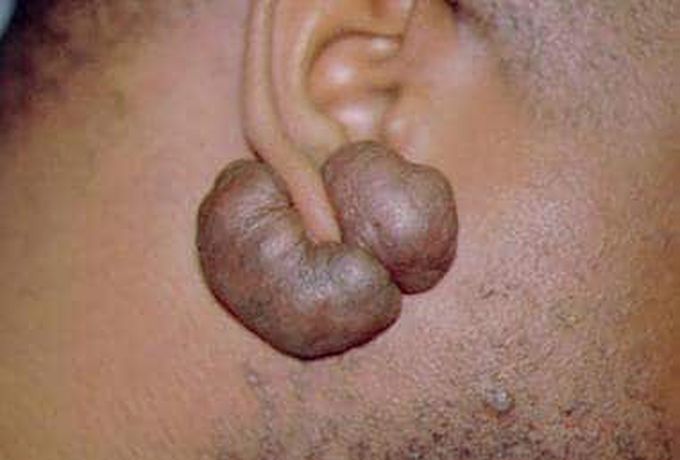 A keloid is an abnormal proliferation of scar tissue that forms at the site of cutaneous injury (eg, on the site of a surgical incision or trauma); it does not regress and grows beyond the original margins of the scar. Keloids should not be confused with hypertrophic scars, which are raised scars that do not grow beyond the boundaries of the original wound and may reduce over time.     ,,,  The symptoms of a keloid can include:

a localized area that is flesh-colored, pink, or red
a lumpy or ridged area of skin that’s usually raised
an area that continues to grow larger with scar tissue over time
an itchy patch of skin 🌸