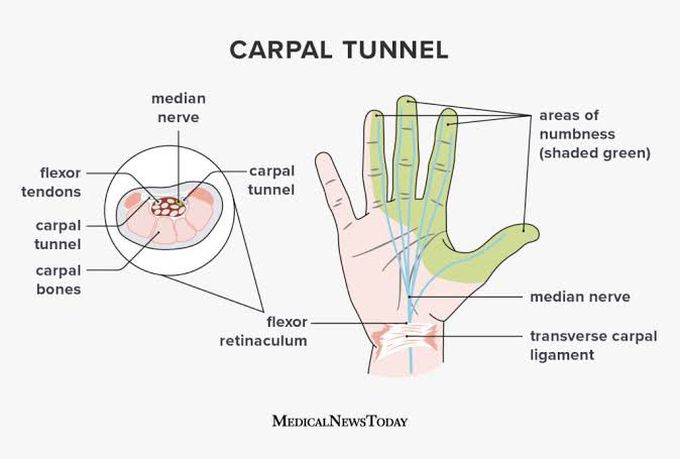 Carpal tunnel syndrome