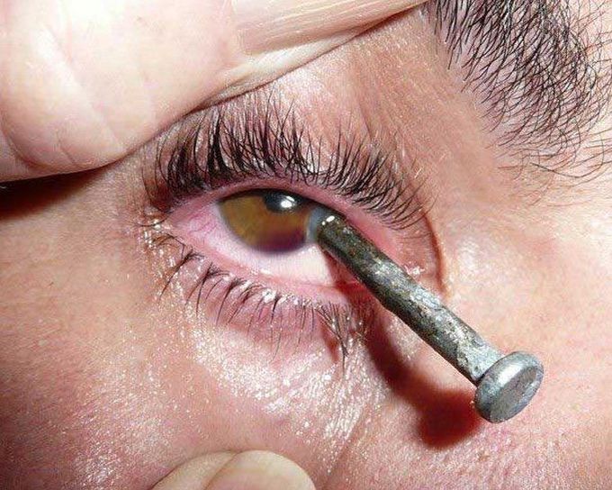 Penetrating eye injury