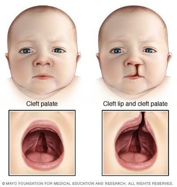 Treatment of cleft palate