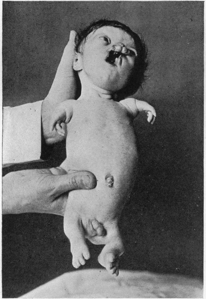 Roberts syndrome