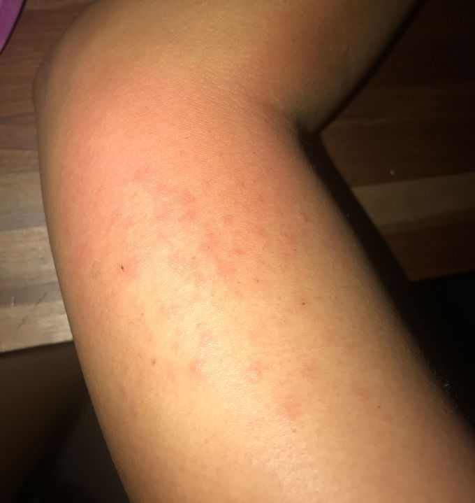 itchy bumps on arms