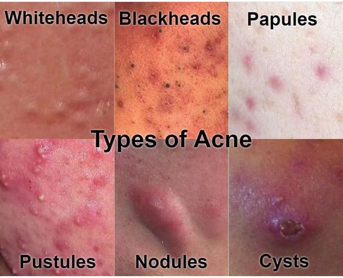 Types of Acne