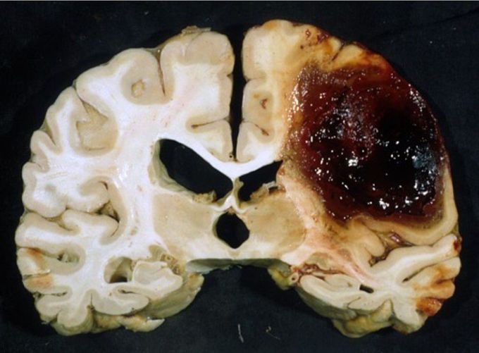 Cerebral amyloid angiopathy