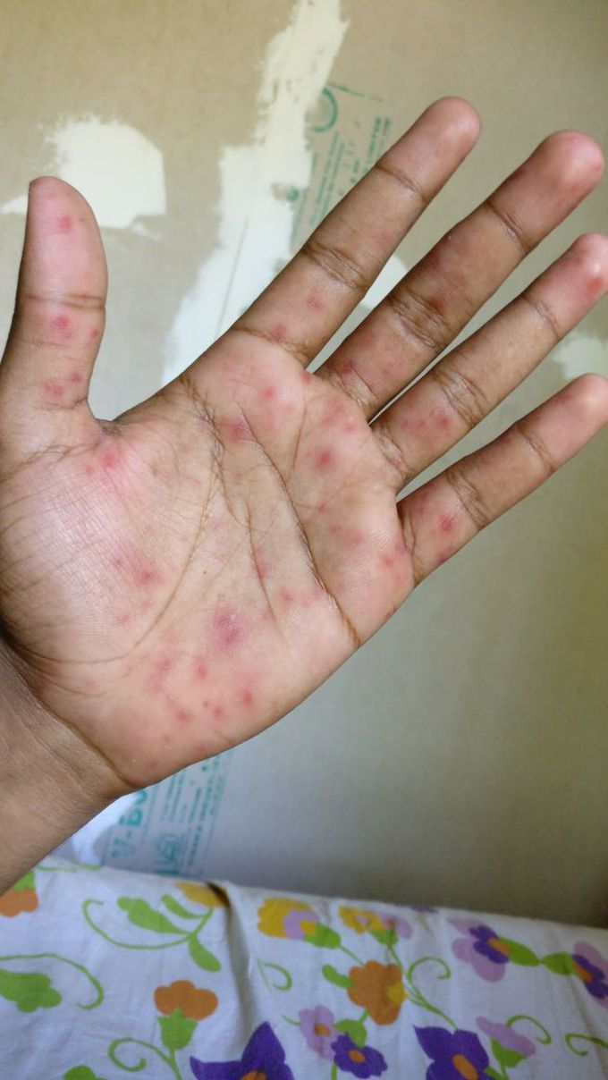 coxsackievirus