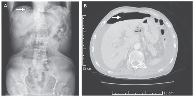 Falciform Ligament Sign