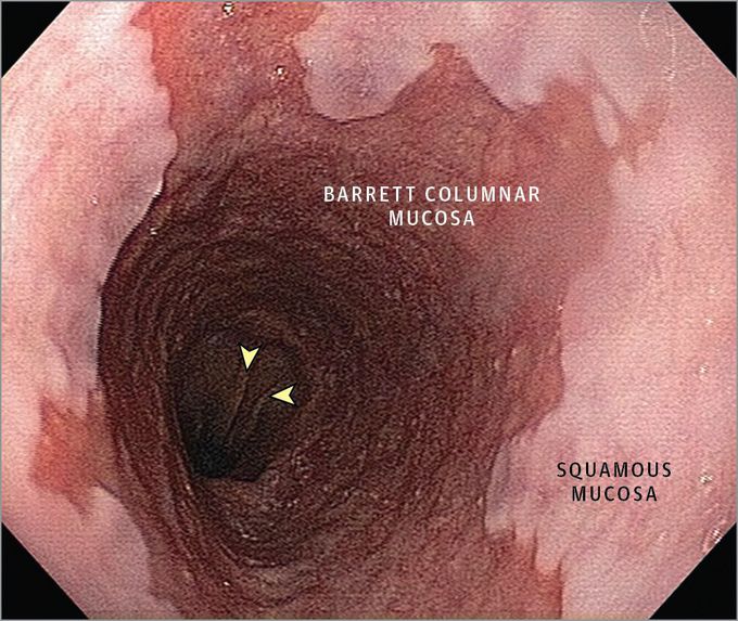 Barrett Esophagus