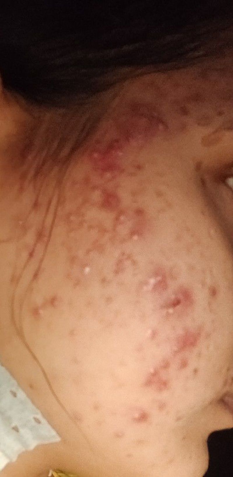 Acne research studies picture