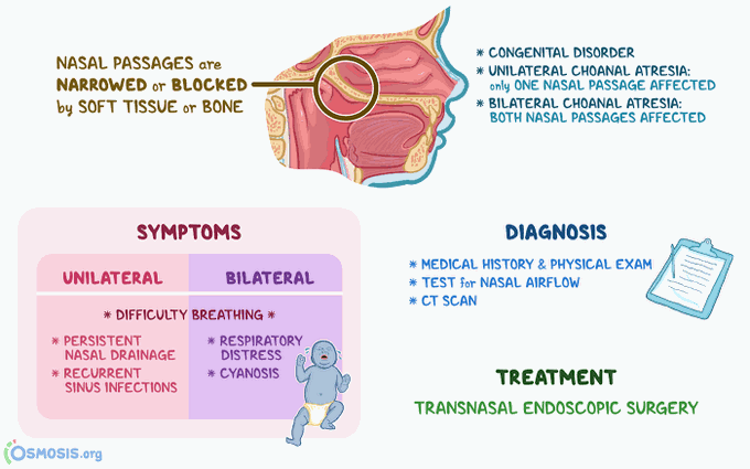Choanal Atresia