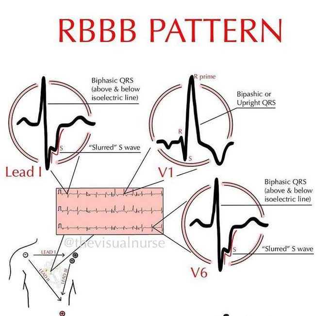 RBBB Pattern