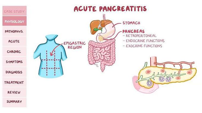 Acute Pancreatitis