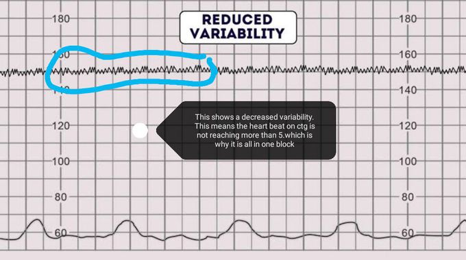 Ctg interpretation