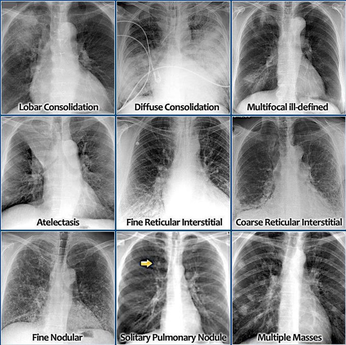 Different lung stage in various ways