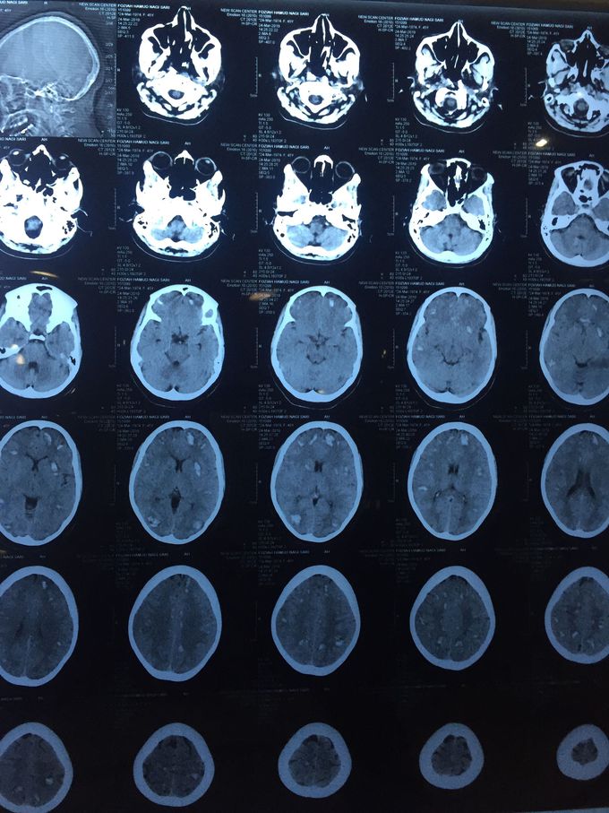 Multiple brain haematoma