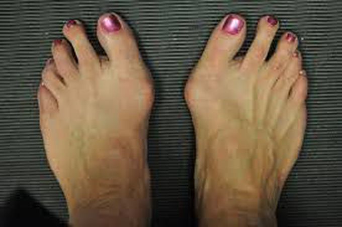 Causes of bunions