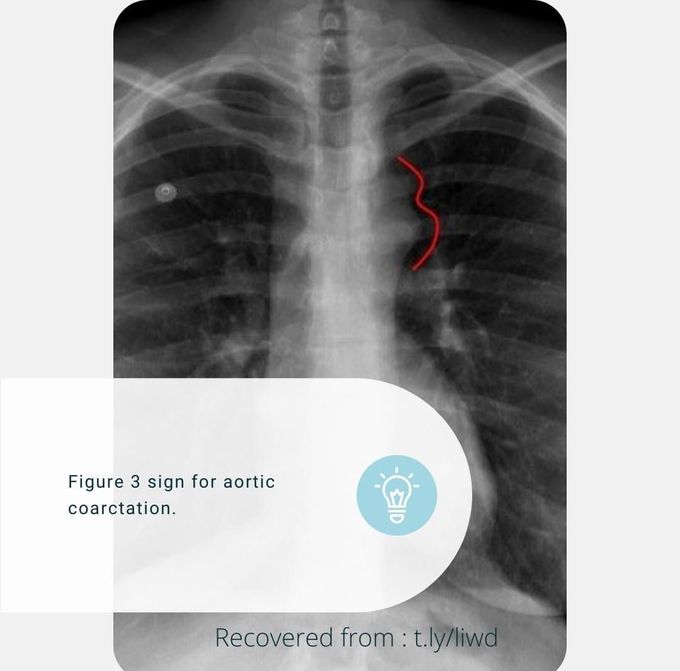 Aortic Coarctation