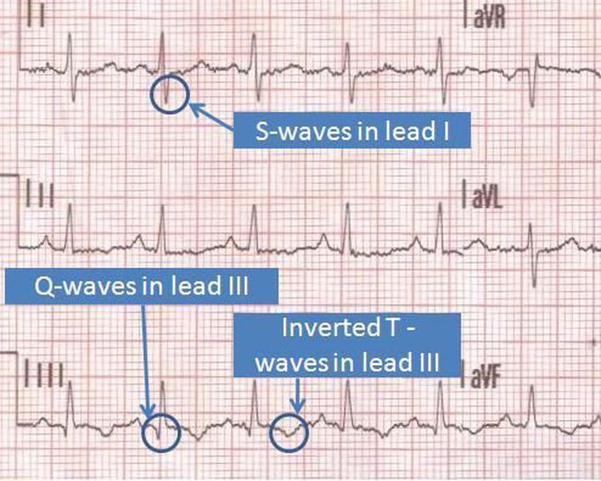 S1Q3T3-Pulmonary Embolism