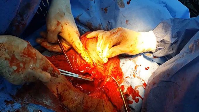 Closure of Uterus During C-Section