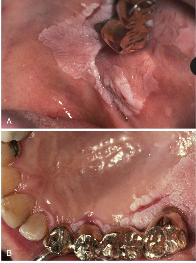 Proliferative Verrucous Leukoplakia (PVL).