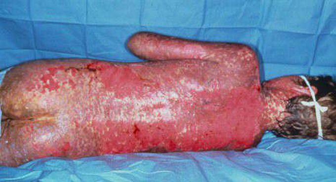 Adverse drug reactions