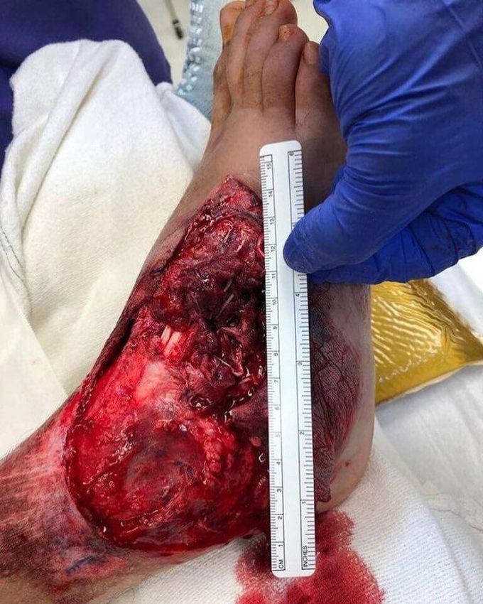 Extensive foot injury