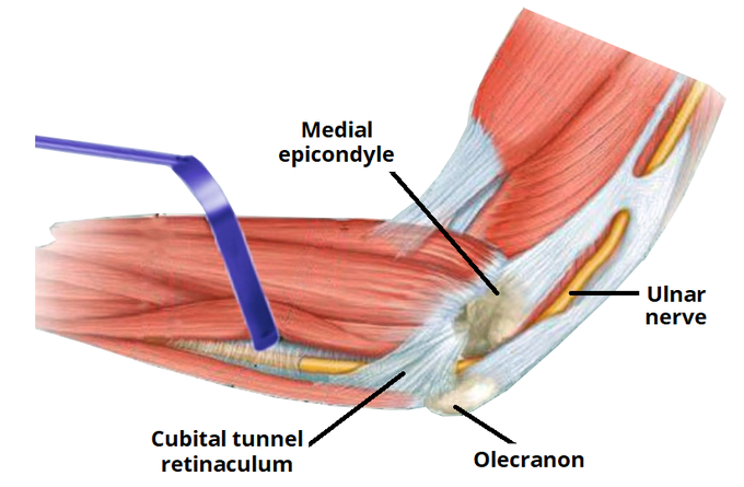 Cubital tunnel syndrome