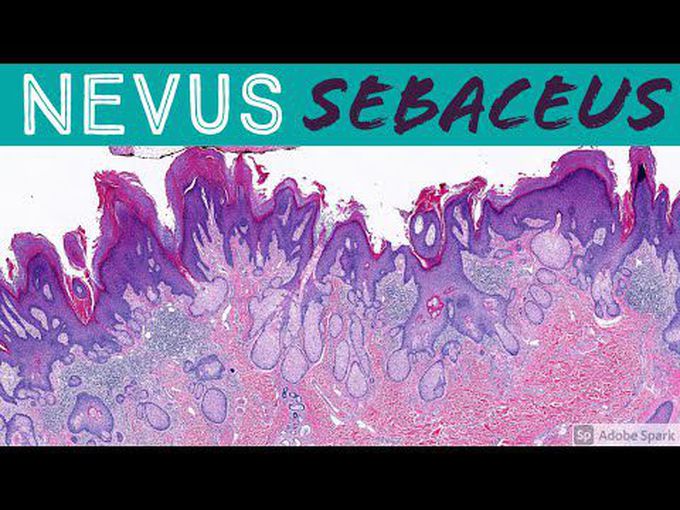 Sebaceous nevus - skin pathology