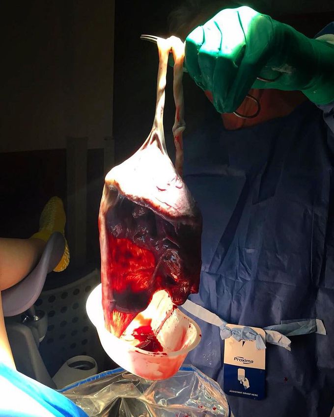 Shine bright, placenta!