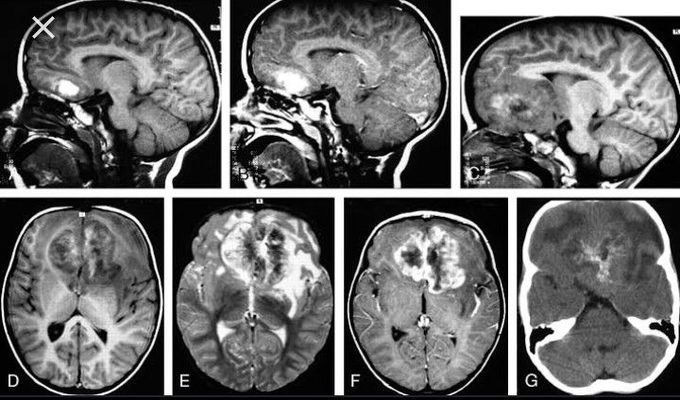 Atypical teratoid rhabdoid tumor