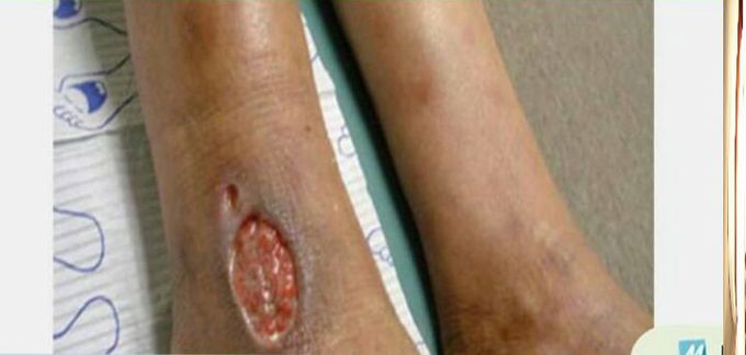 Ulcer!!