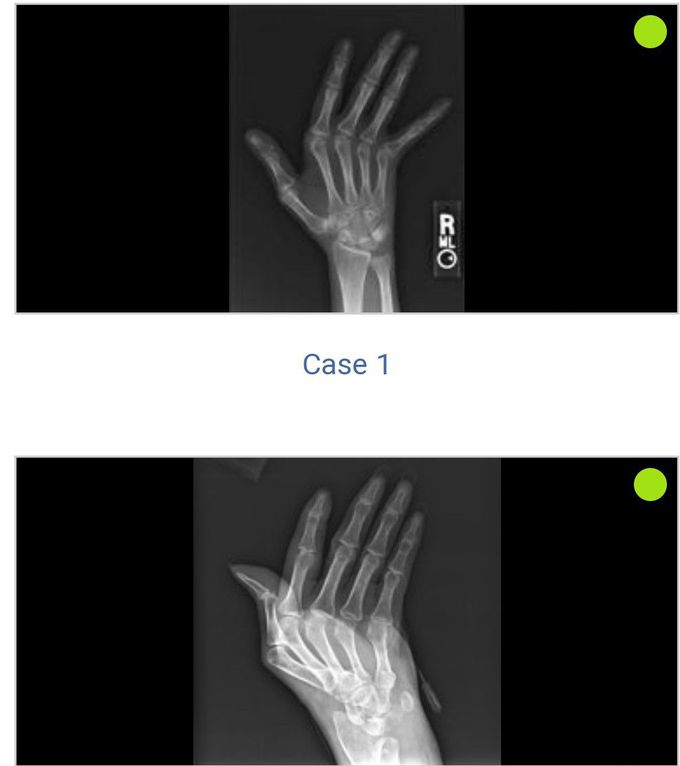 Jaccoud's arthropathy